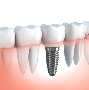 Illustration of dental implants in Kittanning, PA for lower arch