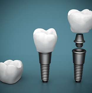 Illustration of different parts of dental implants in Kittanning, PA