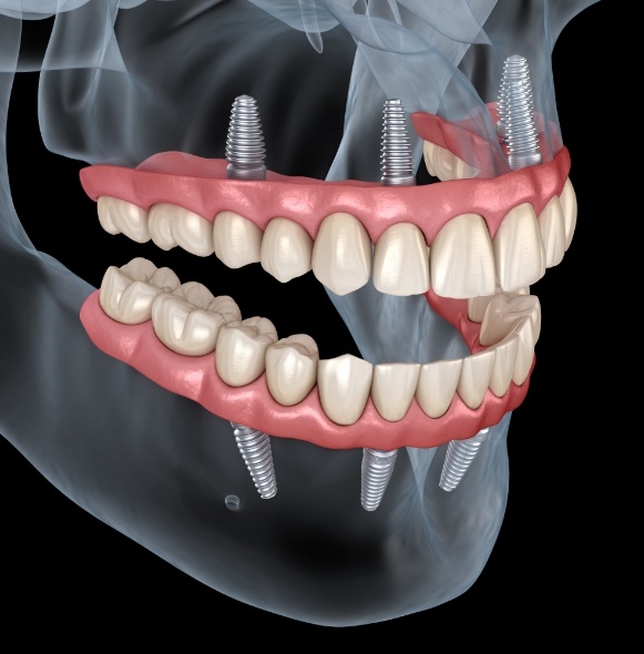 Animated smile with dental implant supported dentures
