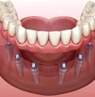 Animated smile during fixed permanent dental implant denture placement