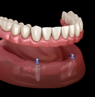 Animated smile during removable dental implant denture placement