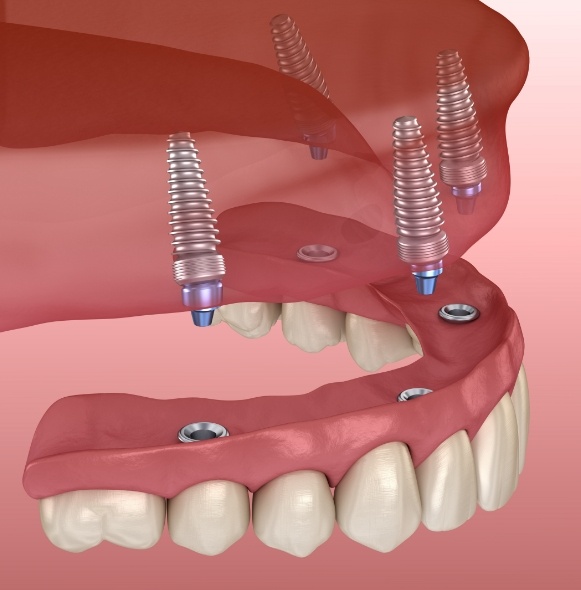 Closeup animation demonstrating the dental implant supported denture placement procedure