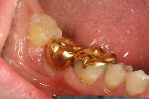 Smile after dental crown was placed on top of dental implant