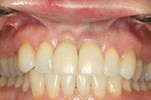 Closeup of perfected smile after dental implant tooth replacement