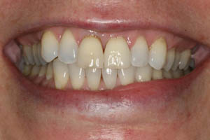 Closeup of smile with damaged teeth before dental implant tooth replacement