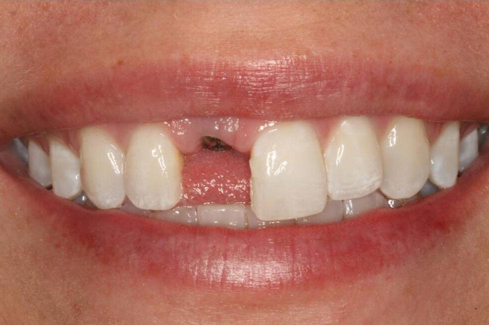 Smile with missing top front tooth