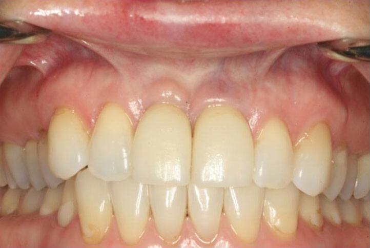 Smile with top two front teeth replaced by dental implant supported dental crowns