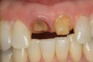 Smile with one missing and one severely damaged top tooth