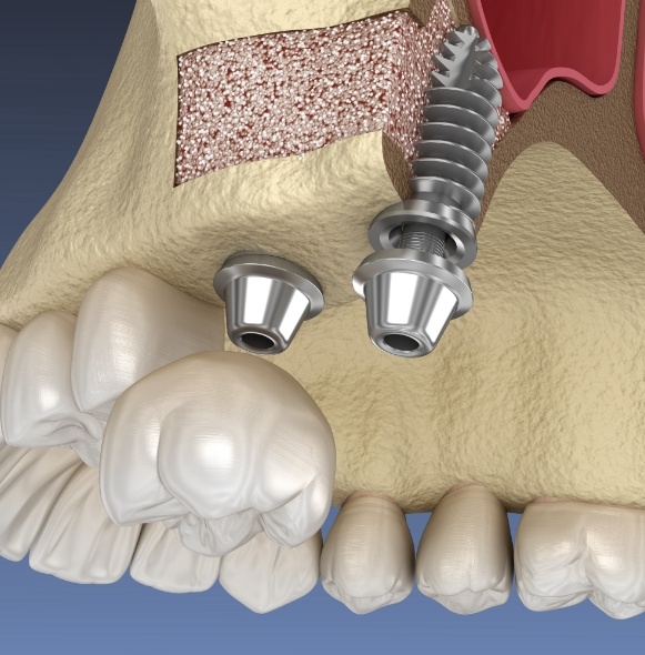 Animated smile during dental implant placement and restoration process