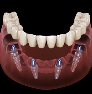 Animated smile during dental implant supported denture placement