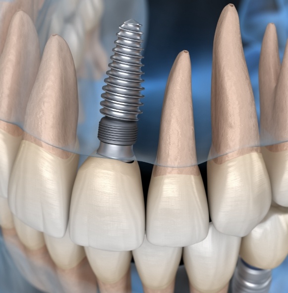 Animated smile showing need to care for dental implant supported replacement tooth like natural teeth