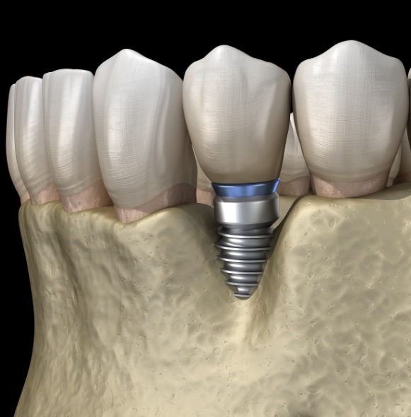 Animated smile comparing dental implant supported tooth to natural teeth