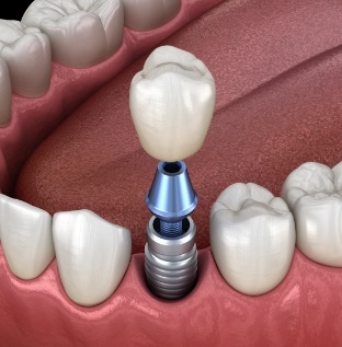 Animated smile during dental implant supported dental crown placement