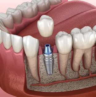 Dental implant in Kittanning  