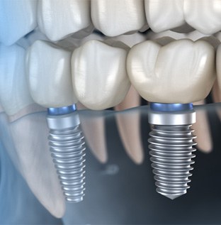 Implant bridge in Kittanning   