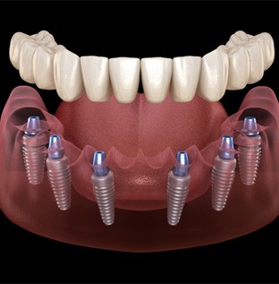 Implant denture in Kittanning    