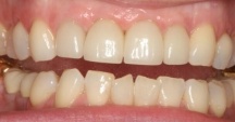 Closeup of full smile after replacing missing teeth