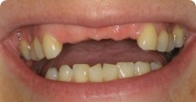 Closeup of patient's smile with several missing teeth