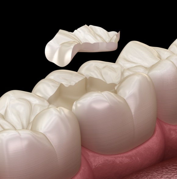 Smile during inlay placement