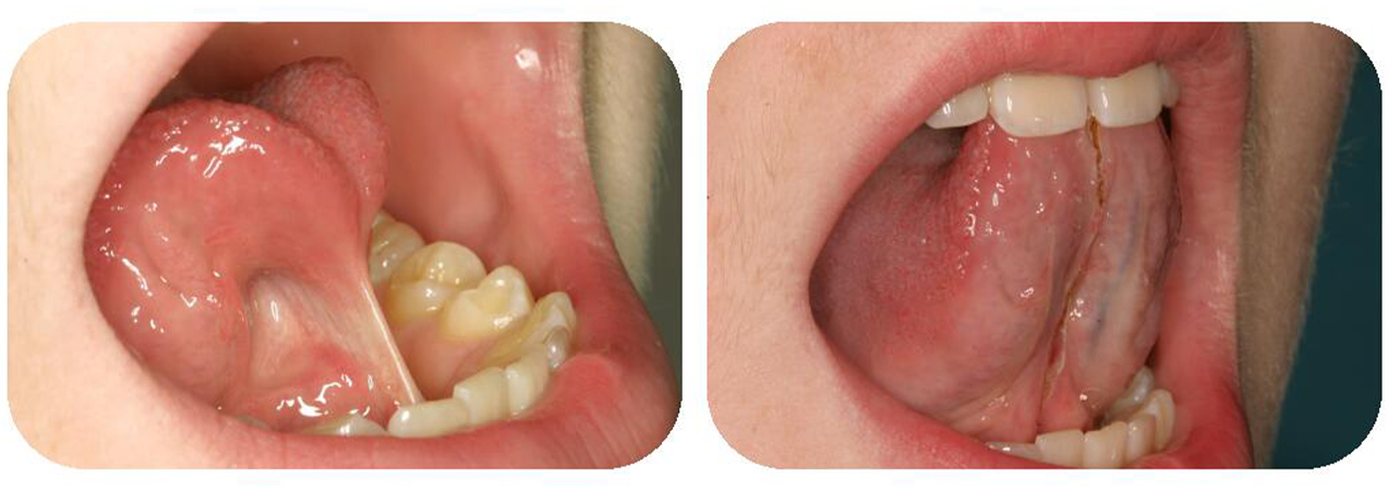 Smile before and after frenectomy for lip and tongue tie