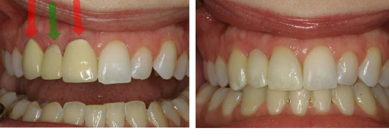 Smile before and after dentl bridge restoration