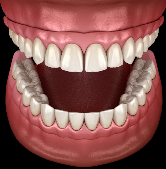 Animated smile with full dentures