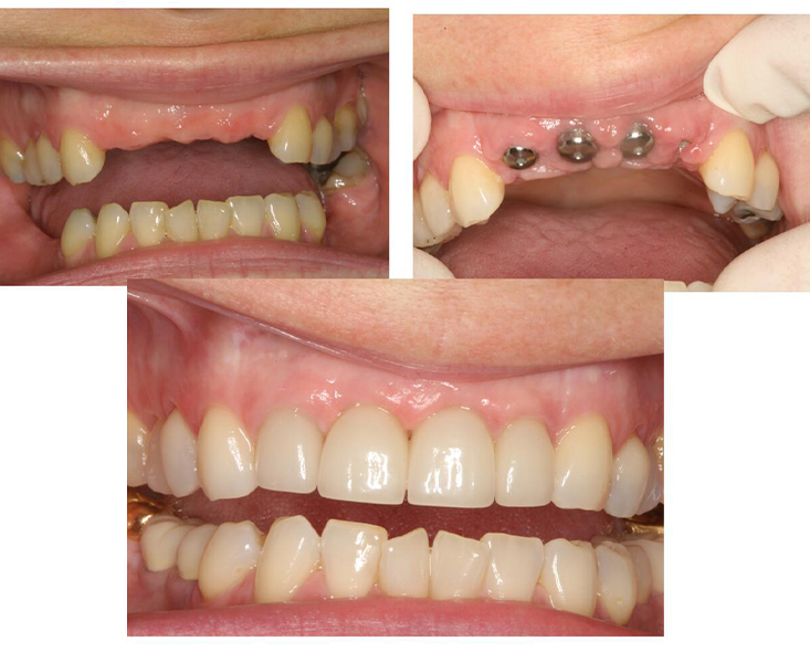 Animated smile before during and after dental implant tooth replacement