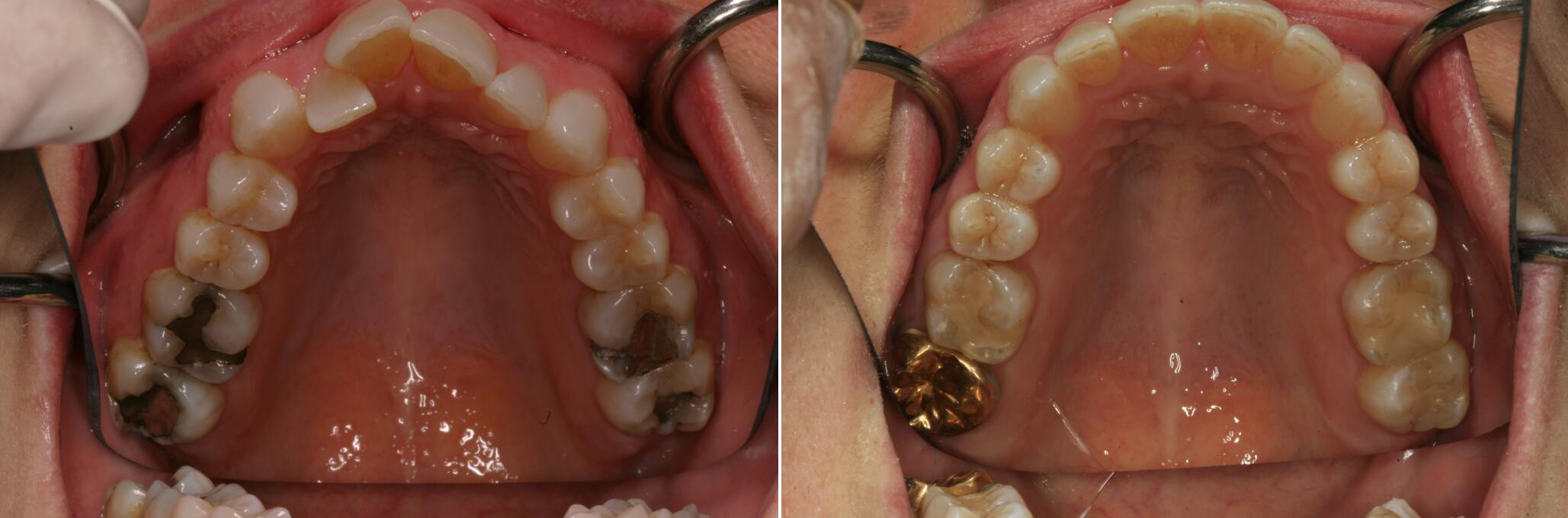 Smile before and after treatment with traditional orthodontics