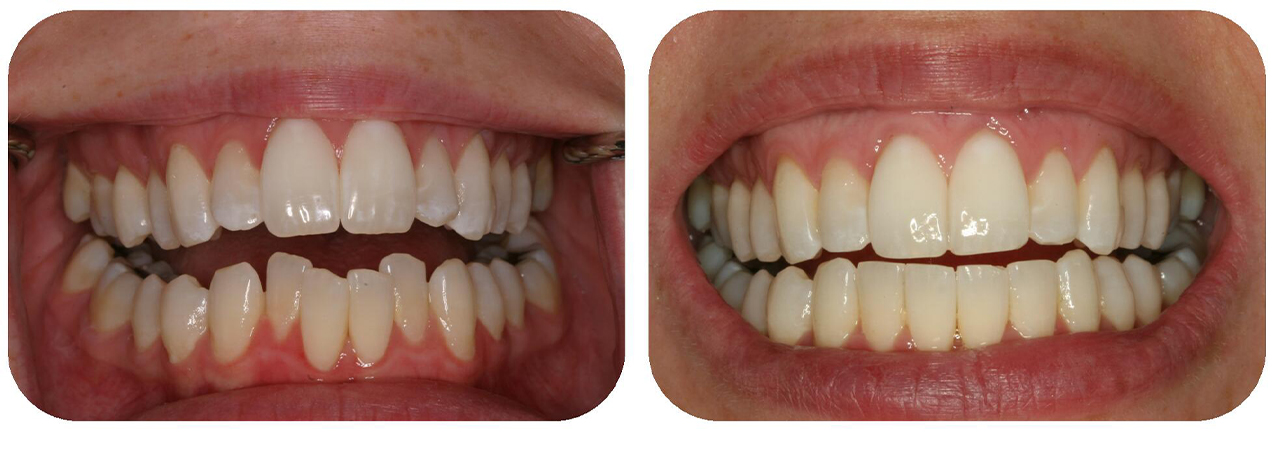 Smile before and after treatment with Invisalign clear aligners