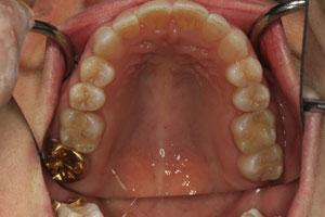Closeup of flawless smile after orthodontic treatment