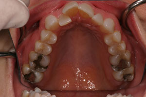 Closeup of crooked smile before orthodontic treatment