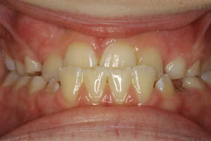 Closeup of smile with underbite before orthodontic treatment