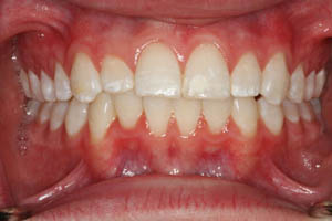 Closeup of teen boy's aligned smile after orthodontic treatment