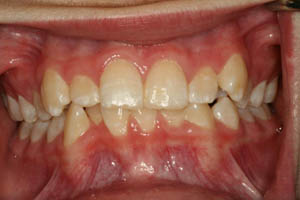 Closeup of teen boy's crooked smile before orthodontic treatment