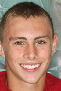 Teen boy with aligned smile after orthodontic treatment