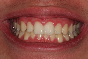 Closeup of patient's smile after closing gaps between teeth with orthodontic treatment