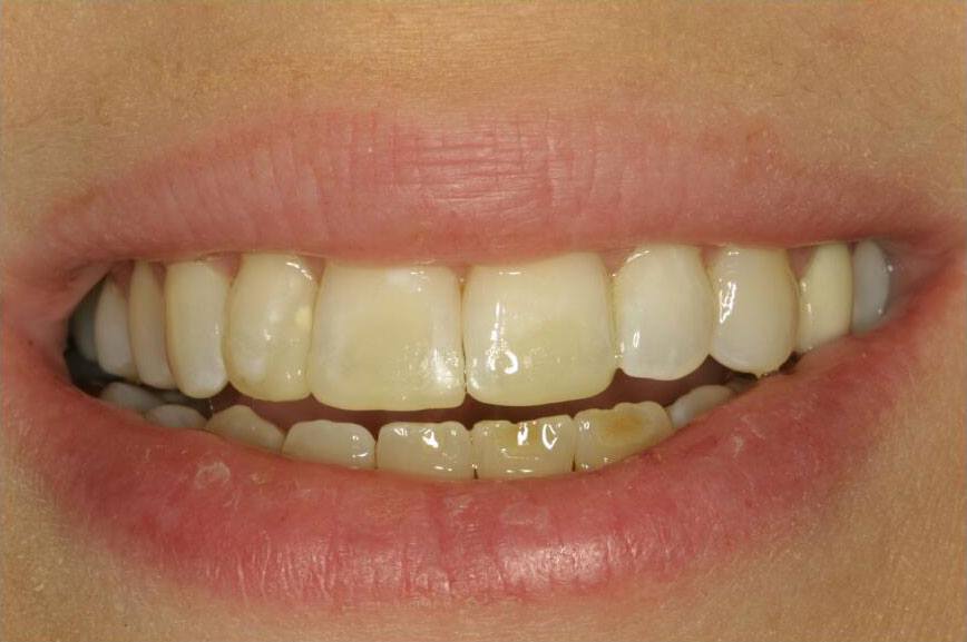 Smile with perfect alignment after orthodontic treatment