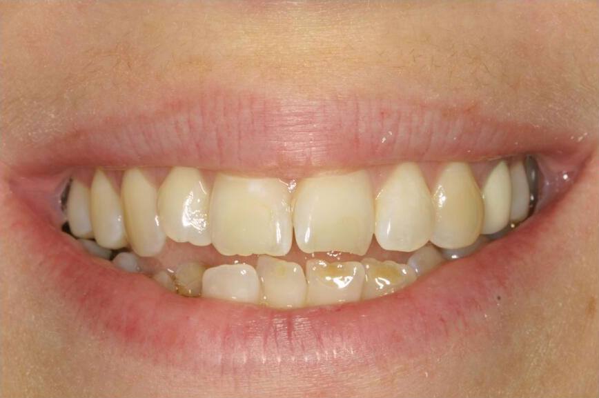Smile with crooked teeth before orthodontic treatment