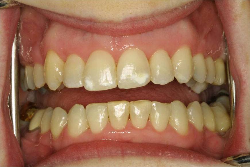Closeup of smile with properly aligned and spaced teeth