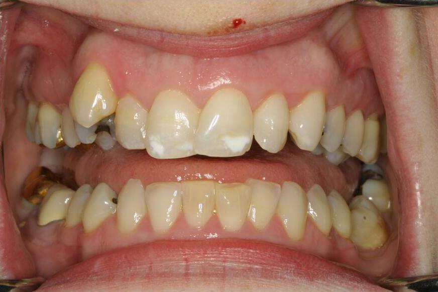 Closeup of smile with crowded teeth