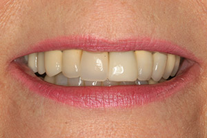 Closeup of discolored smile before dental crown treatment