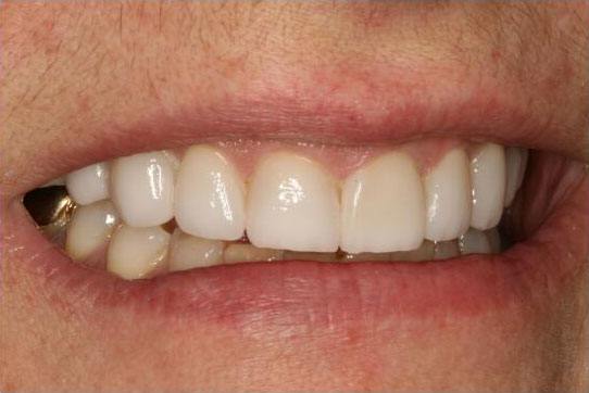 Closeup of smile with porcelain dental crowns replacing metal dental crowns