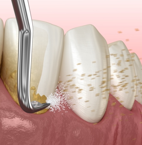 Animated smile during scaling and root planing periodontal therapy