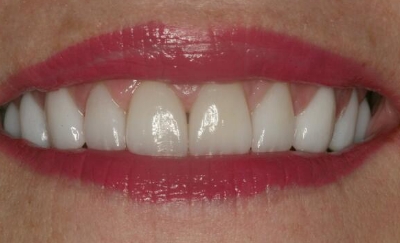 Bright white perfectly aligned smile after dental crown restoration