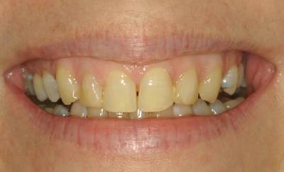 Discolored and misaligned smile before dental crown restoration