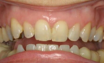 Smile with several worn or damaged top teeth