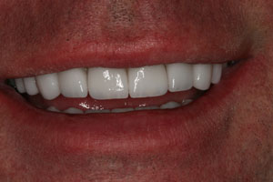 Closeup of smile after porcelain dental crown restoration