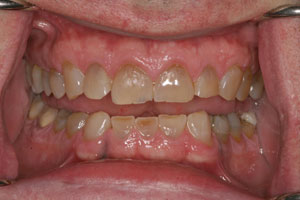 Closeup of smile before porcelain dental crown restoration
