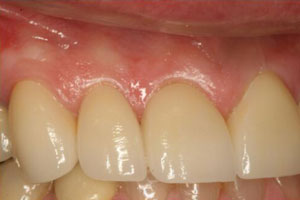 Closeup of smile damaged tooth seamlessly repaired with dental crown