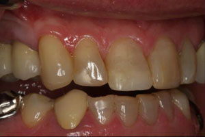 Closeup of smile with damaged tooth before dental crown restoration